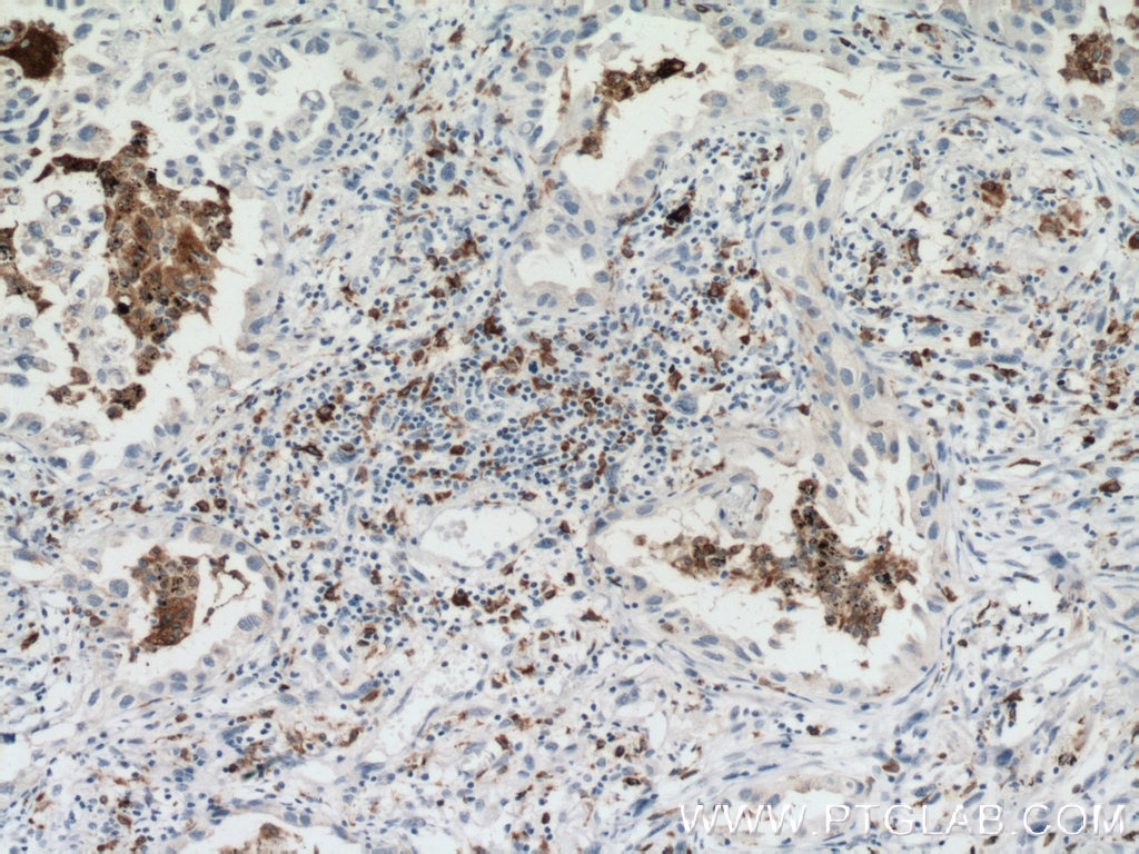 Immunohistochemistry (IHC) staining of human lung cancer tissue using CD68 Monoclonal antibody (66231-2-Ig)