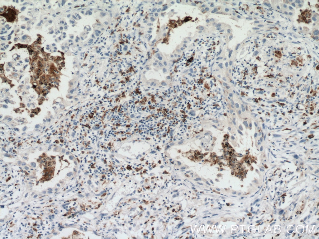 IHC staining of human lung cancer using 66231-2-Ig