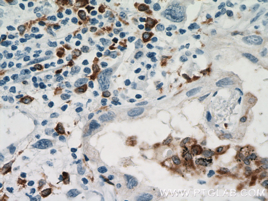 Immunohistochemistry (IHC) staining of human lung cancer tissue using CD68 Monoclonal antibody (66231-2-Ig)