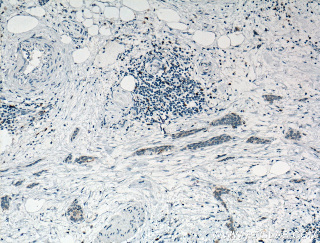 IHC staining of human urothelial carcinoma using 66231-2-Ig