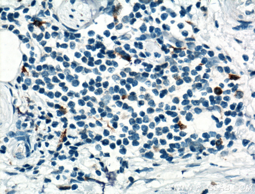 Immunohistochemistry (IHC) staining of human urothelial carcinoma tissue using CD68 Monoclonal antibody (66231-2-Ig)