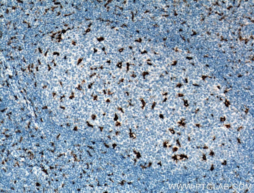 Immunohistochemistry (IHC) staining of human tonsillitis tissue using CD68 Monoclonal antibody (66231-2-Ig)