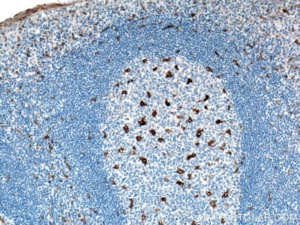 Immunohistochemistry (IHC) staining of human tonsillitis tissue using CD68 Monoclonal antibody (66231-2-Ig)