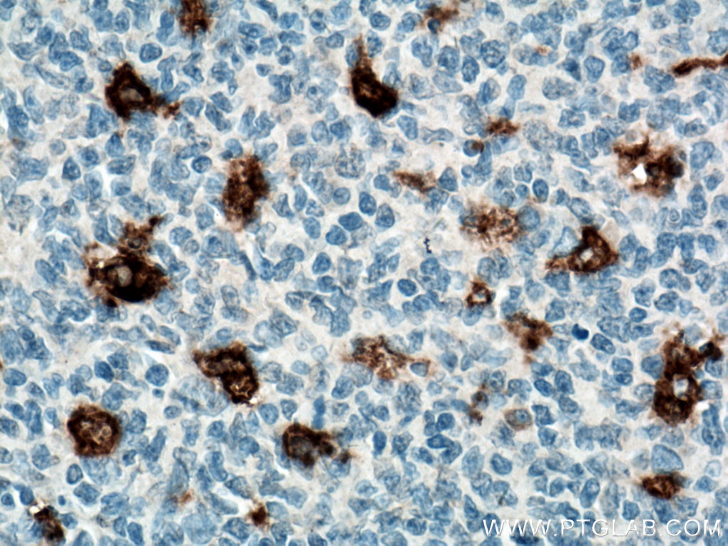 IHC staining of human tonsillitis using 66231-2-Ig