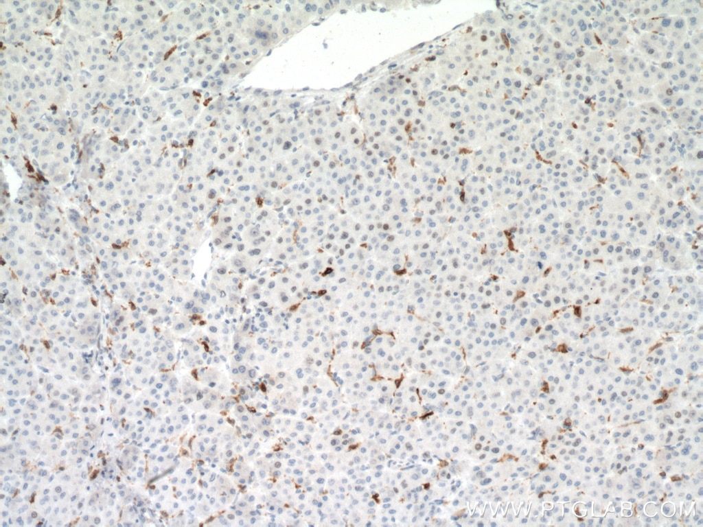 Immunohistochemistry (IHC) staining of human liver cancer tissue using CD68 Monoclonal antibody (66231-2-Ig)