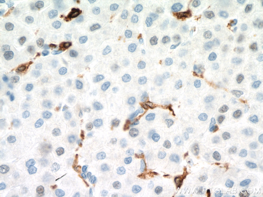Immunohistochemistry (IHC) staining of human liver cancer tissue using CD68 Monoclonal antibody (66231-2-Ig)