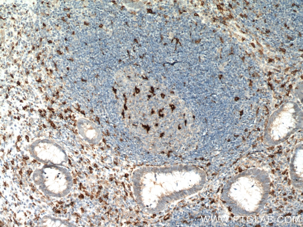 Immunohistochemistry (IHC) staining of human appendicitis tissue using CD68 Monoclonal antibody (66231-2-Ig)