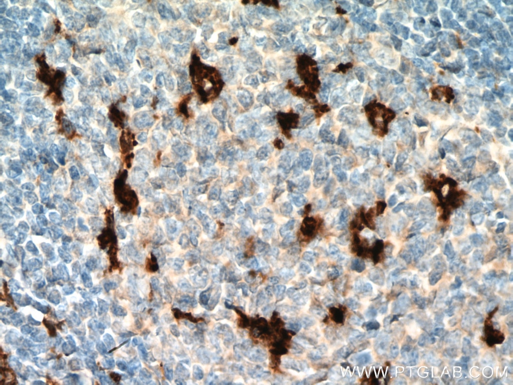 Immunohistochemistry (IHC) staining of human appendicitis tissue using CD68 Monoclonal antibody (66231-2-Ig)