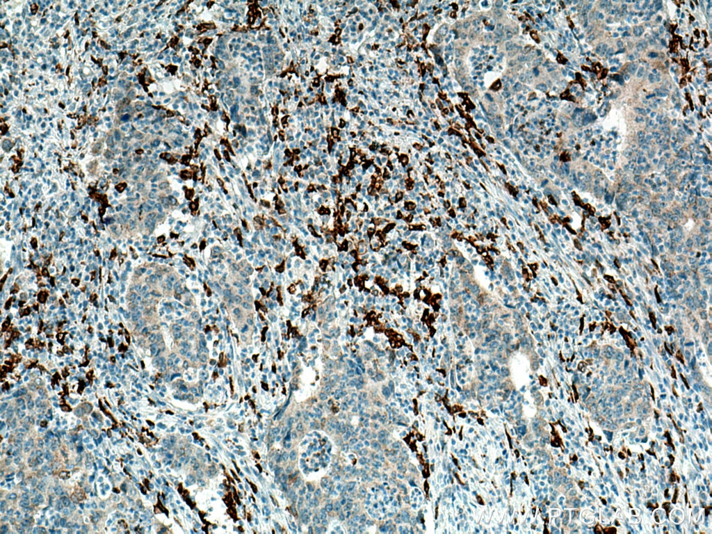 Immunohistochemistry (IHC) staining of human colon cancer tissue using CD68 Monoclonal antibody (66231-2-Ig)