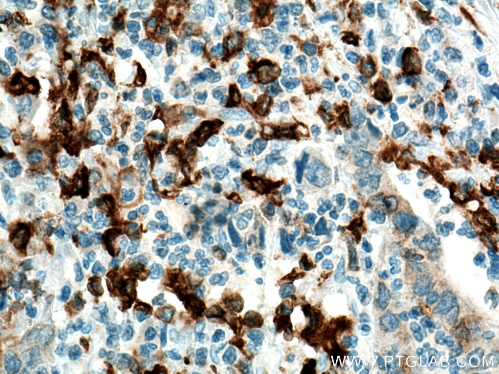 Immunohistochemistry (IHC) staining of human colon cancer tissue using CD68 Monoclonal antibody (66231-2-Ig)