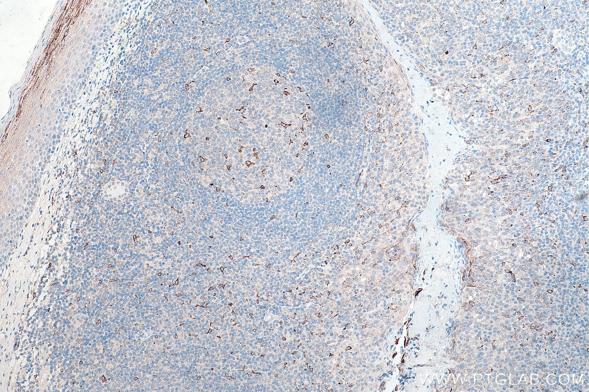 IHC staining of human tonsillitis using 66231-2-Ig Immunohistochemistry (IHC) staining of human tonsillitis tissue using CD68 Monoclonal antibody (66231-2-Ig)