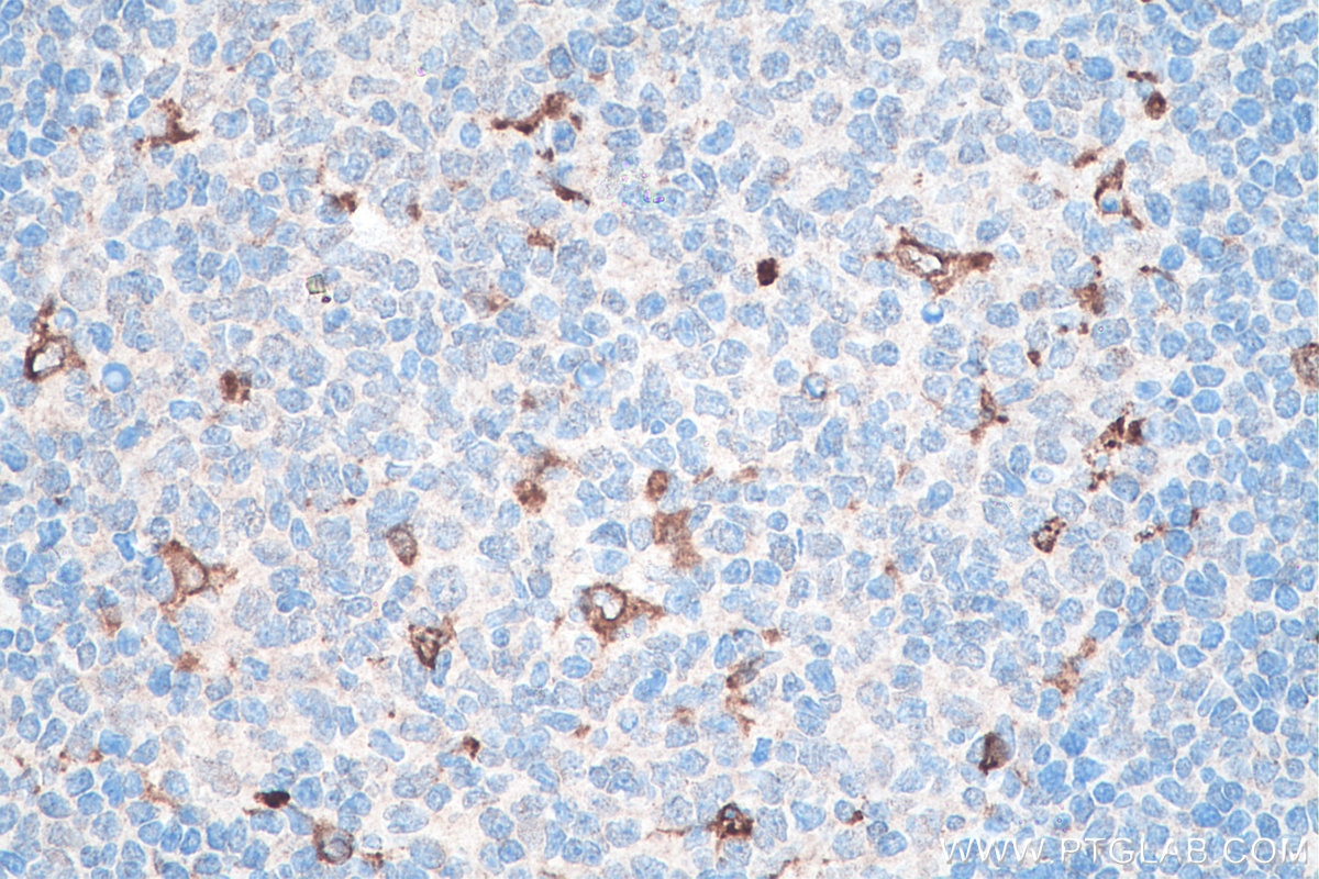 IHC staining of human tonsillitis using 66231-2-Ig Immunohistochemistry (IHC) staining of human tonsillitis tissue using CD68 Monoclonal antibody (66231-2-Ig)
