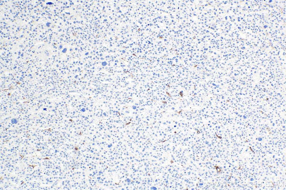IHC staining of human liver cancer using 66231-2-Ig Immunohistochemistry (IHC) staining of human liver cancer tissue using CD68 Monoclonal antibody (66231-2-Ig)