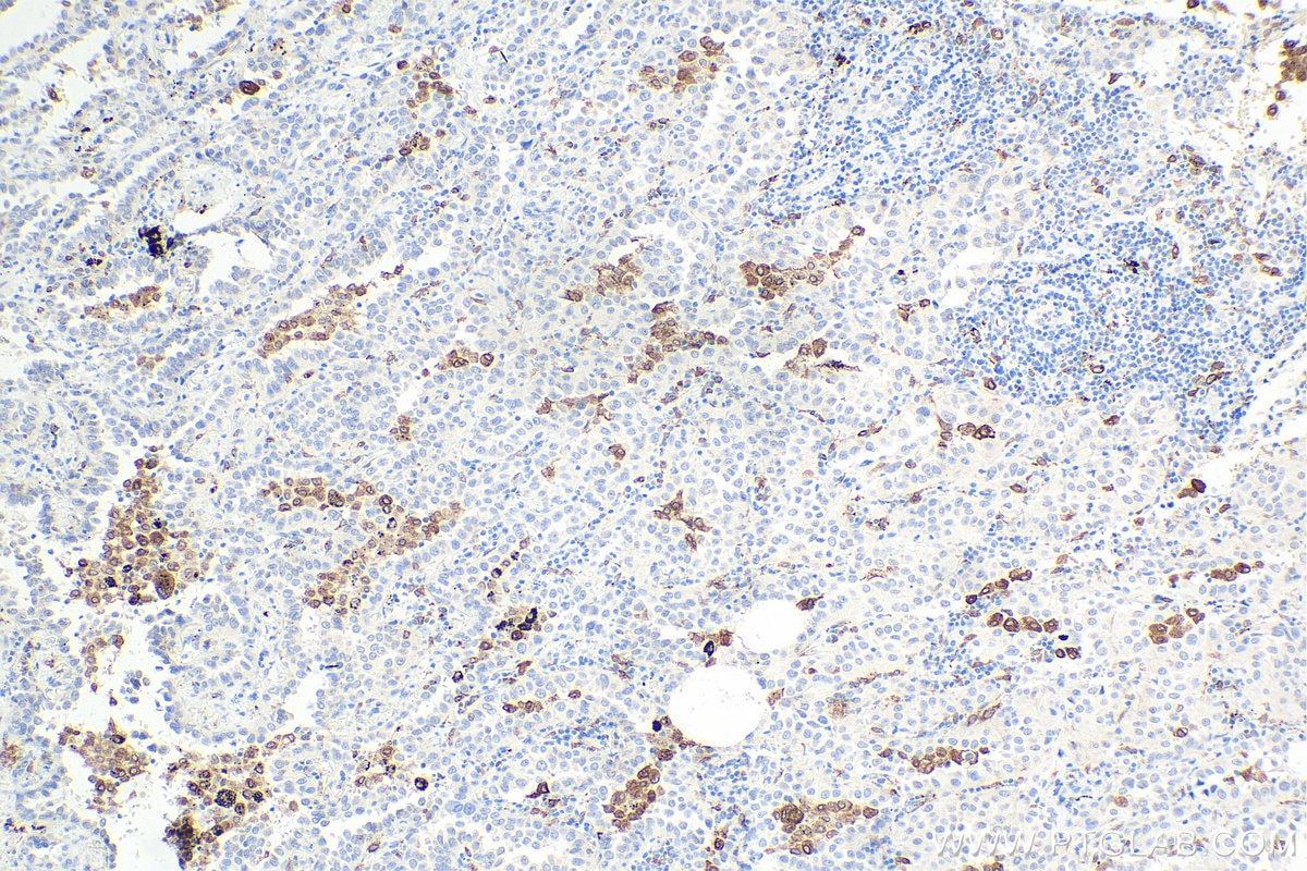 IHC staining of human lung cancer using 66231-2-Ig Immunohistochemistry (IHC) staining of human lung cancer tissue using CD68 Monoclonal antibody (66231-2-Ig)