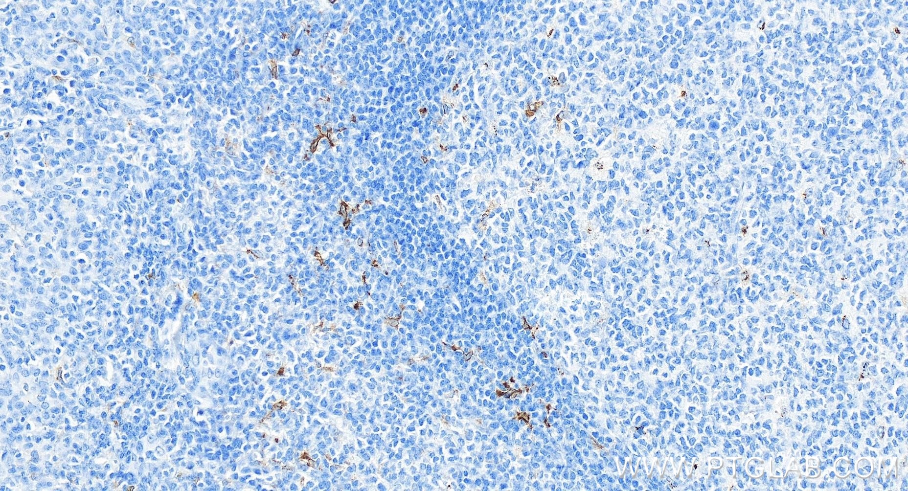 Immunohistochemistry (IHC) staining of human tonsillitis tissue using CD68 Recombinant antibody (84596-4-RR)