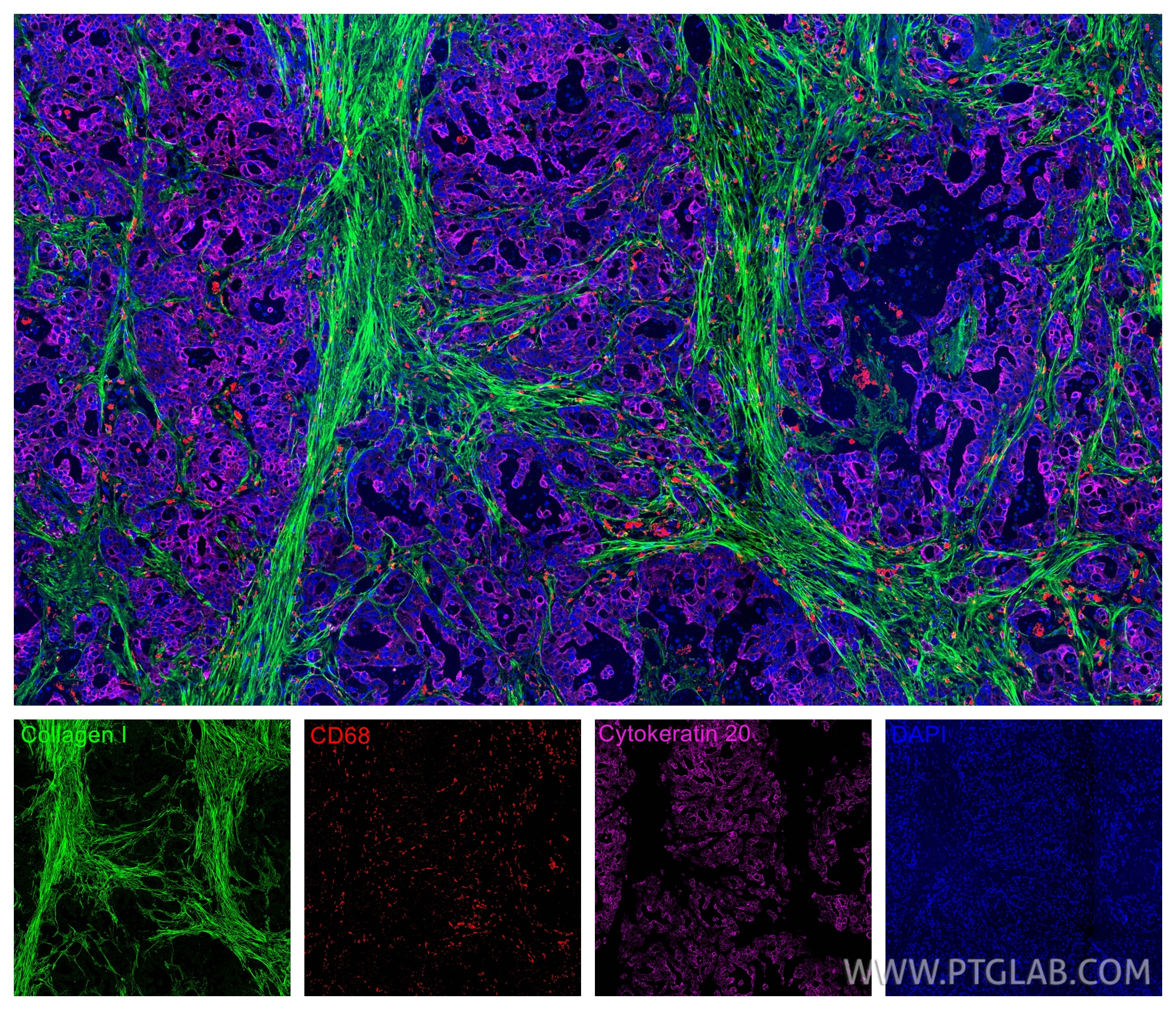 Immunofluorescence (IF) / fluorescent staining of human colon cancer tissue using CoraLite®594-conjugated CD68 Polyclonal antibody (CL594-25747)