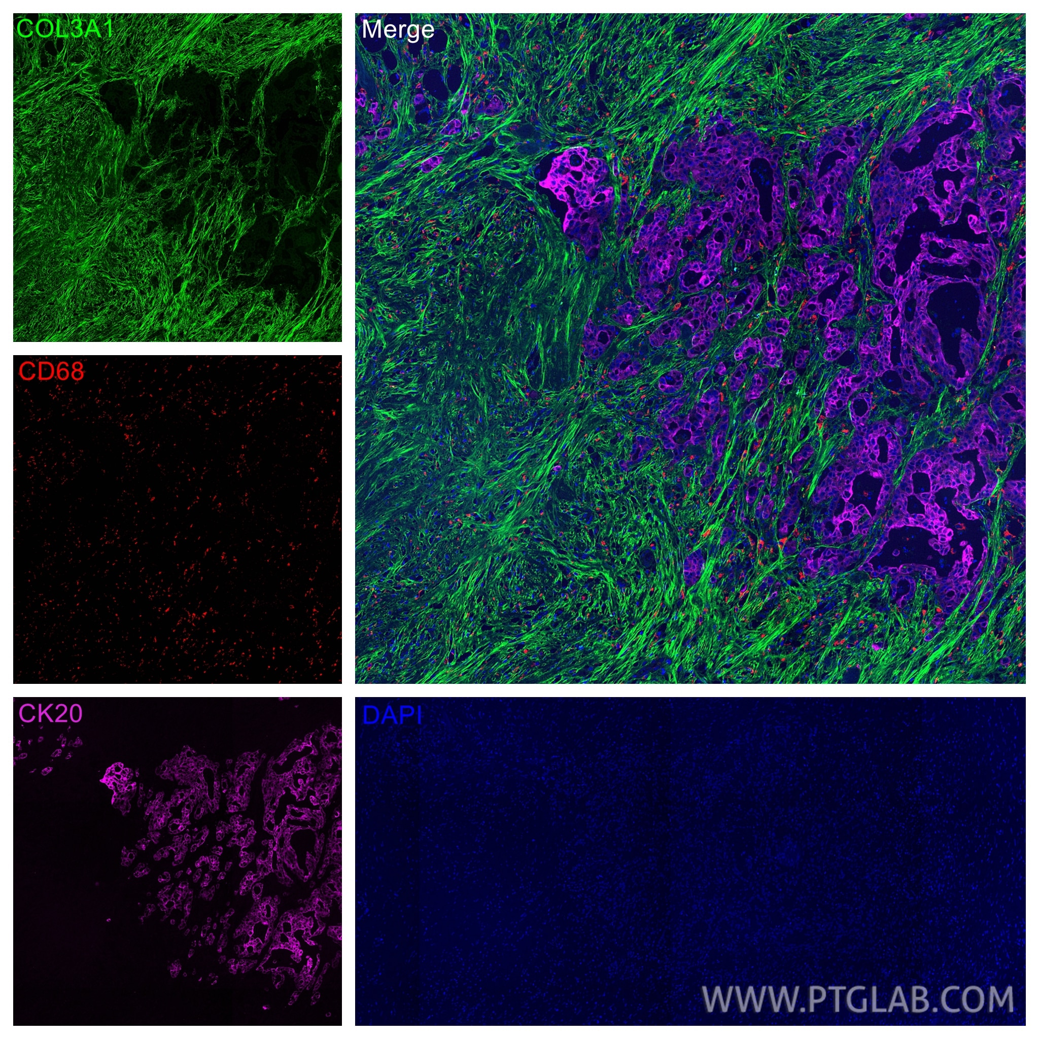 IF Staining of human colon cancer using CL594-25747 Immunofluorescence (IF) / fluorescent staining of human colon cancer tissue using CoraLite®594-conjugated CD68 Polyclonal antibody (CL594-25747)