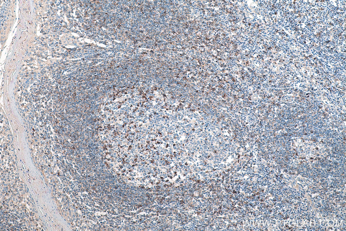 Immunohistochemistry (IHC) staining of human tonsillitis tissue using CD69 Polyclonal antibody (10803-1-AP)