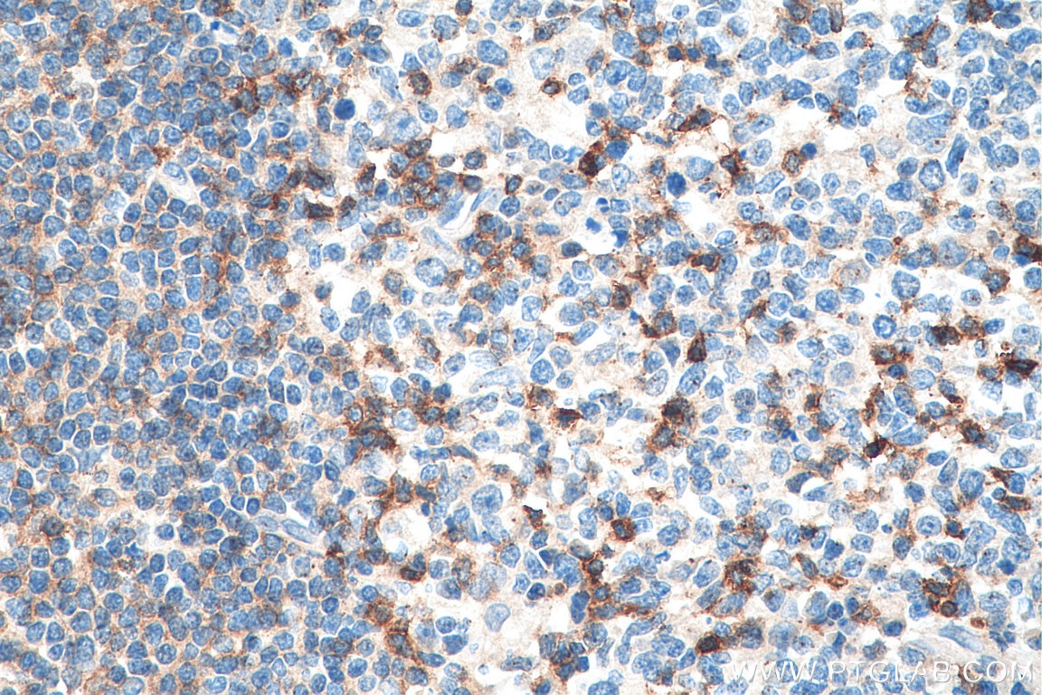 Immunohistochemistry (IHC) staining of human tonsillitis tissue using CD69 Polyclonal antibody (10803-1-AP)