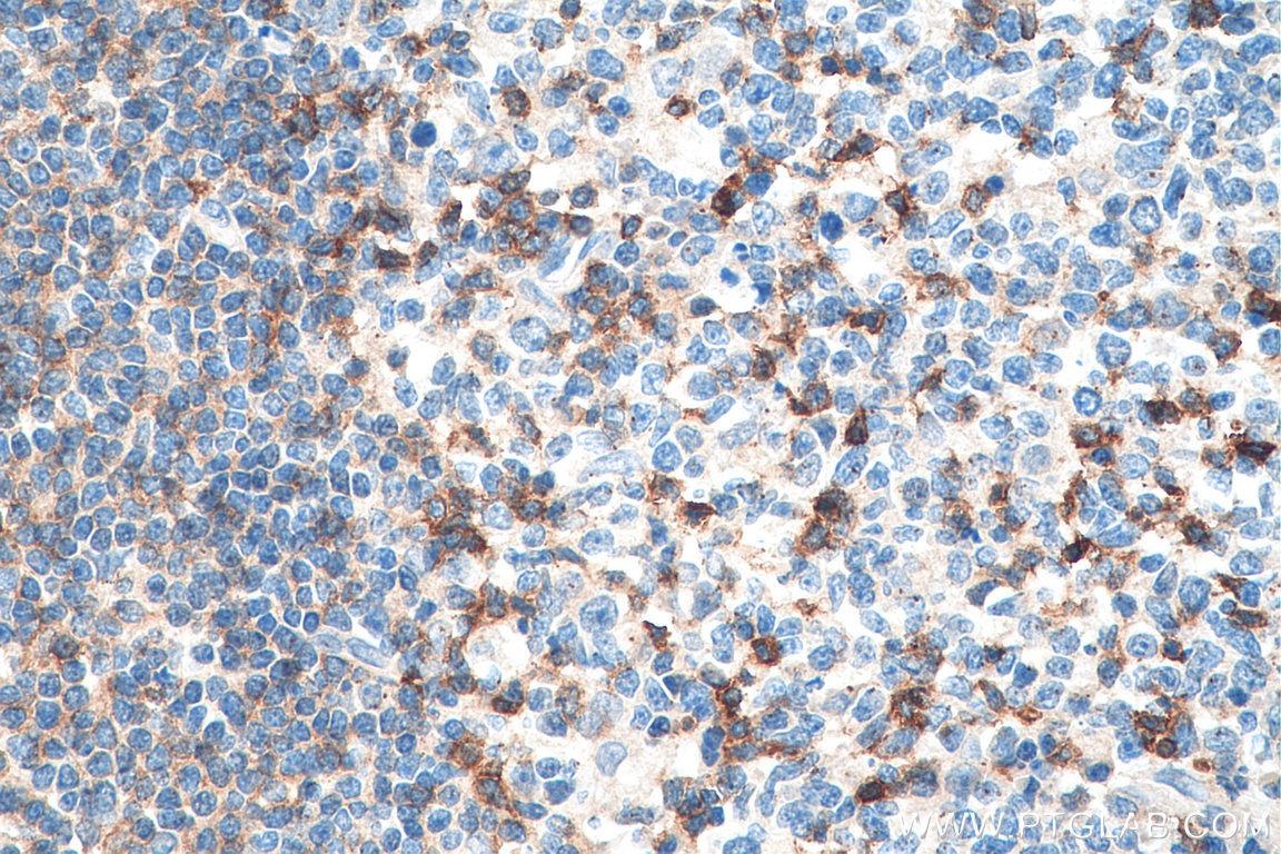 IHC staining of human tonsillitis using 10803-1-AP