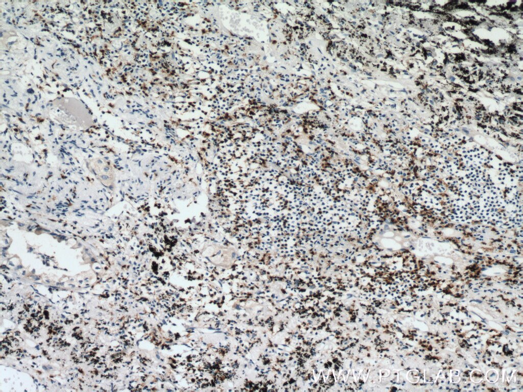Immunohistochemistry (IHC) staining of human lung cancer tissue using CD7 Polyclonal antibody (11320-1-AP)