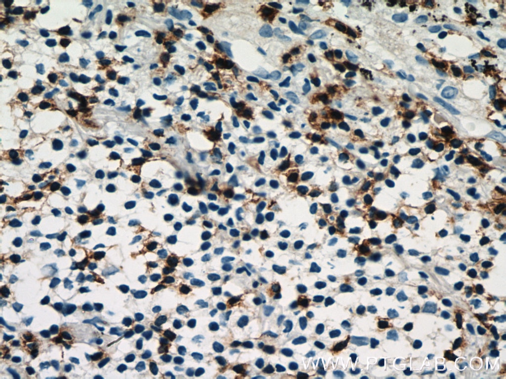 Immunohistochemistry (IHC) staining of human lung cancer tissue using CD7 Polyclonal antibody (11320-1-AP)