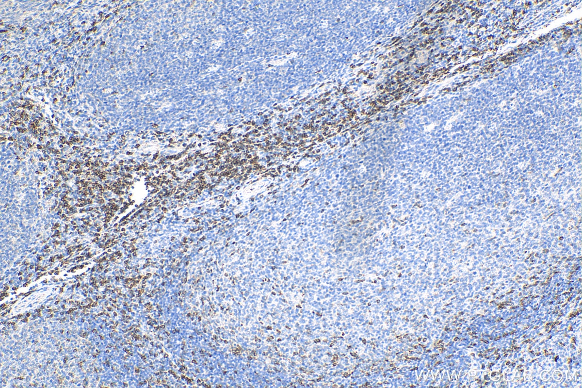 Immunohistochemistry (IHC) staining of human tonsillitis tissue using CD7 Polyclonal antibody (11320-1-AP)