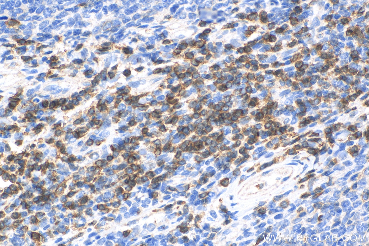 Immunohistochemistry (IHC) staining of human tonsillitis tissue using CD7 Polyclonal antibody (11320-1-AP)