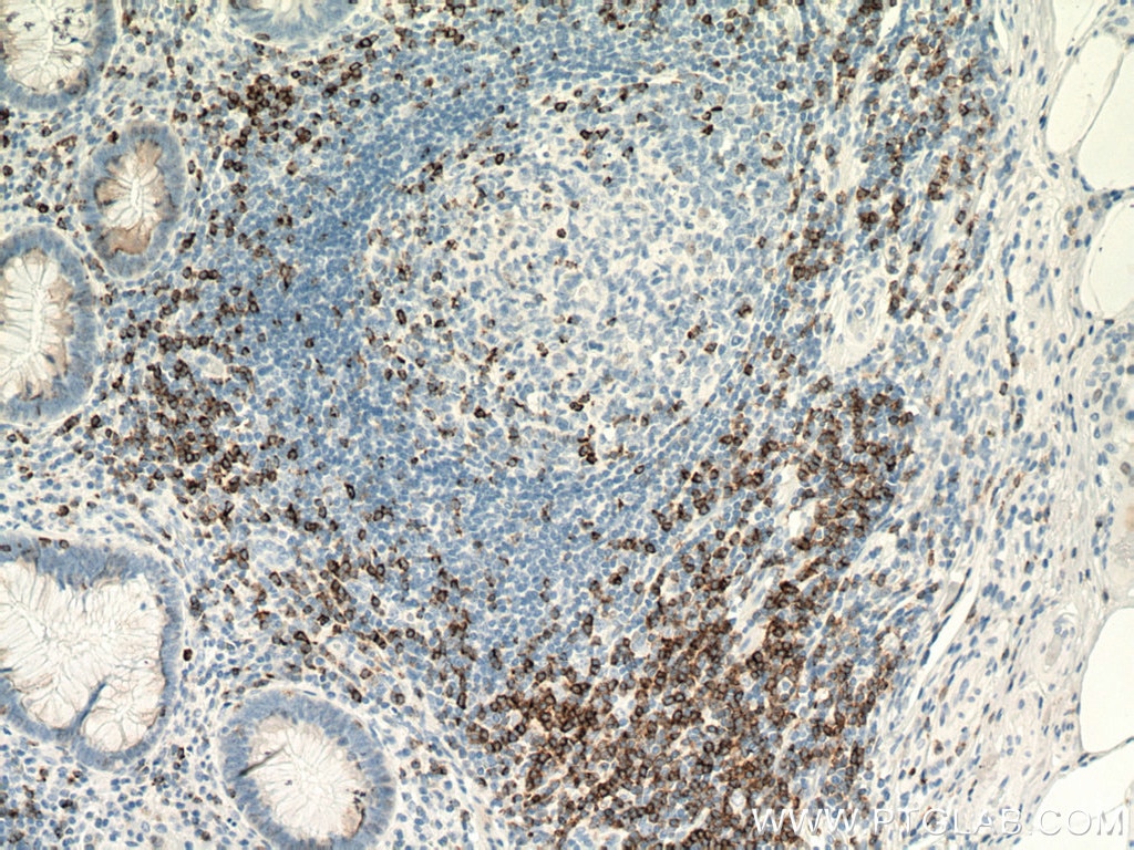 Immunohistochemistry (IHC) staining of human appendicitis tissue using CD7 Monoclonal antibody (60209-1-Ig)