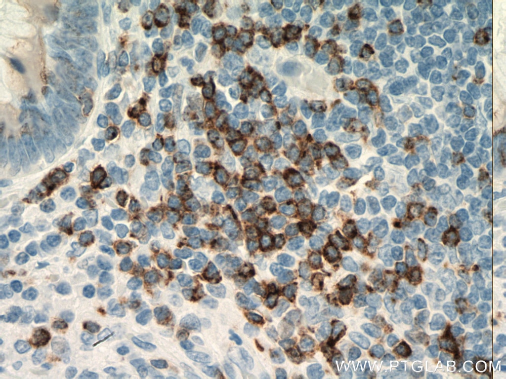 Immunohistochemistry (IHC) staining of human appendicitis tissue using CD7 Monoclonal antibody (60209-1-Ig)