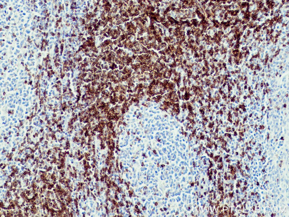 IHC staining of human tonsillitis using 60209-1-Ig