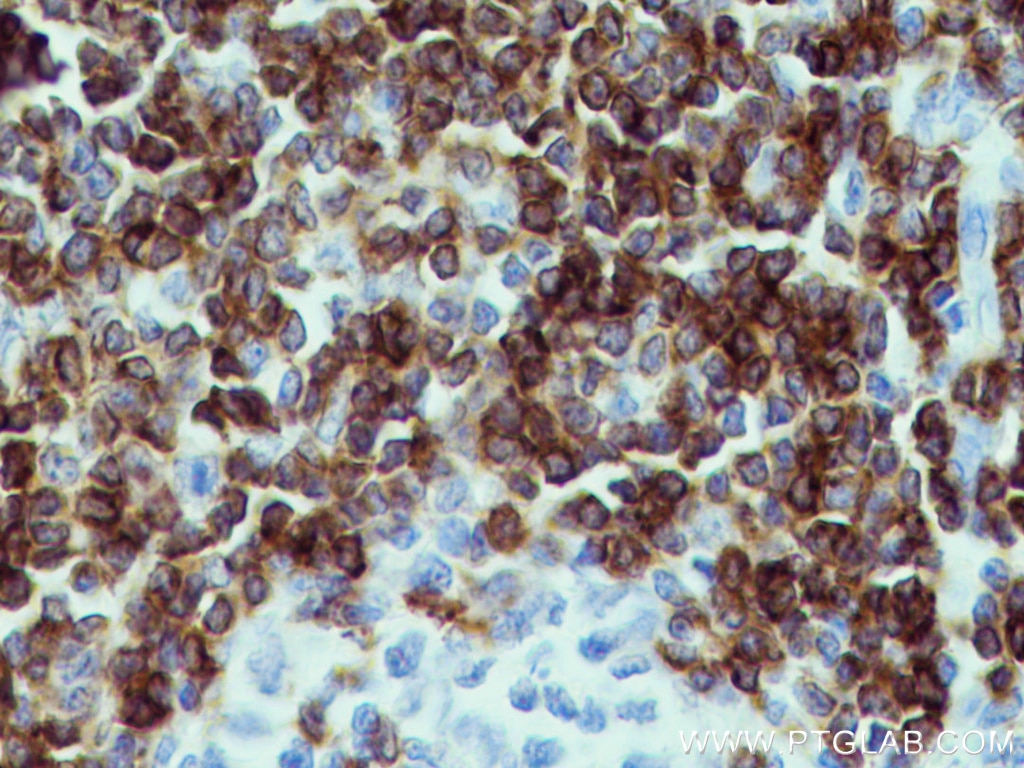Immunohistochemistry (IHC) staining of human tonsillitis tissue using CD7 Monoclonal antibody (60209-1-Ig)