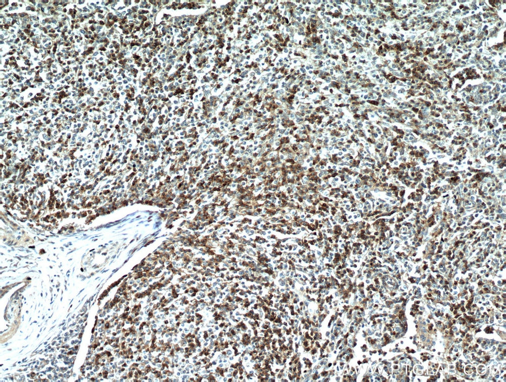 Immunohistochemistry (IHC) staining of human lymphoma tissue using CD7 Monoclonal antibody (60209-1-Ig)