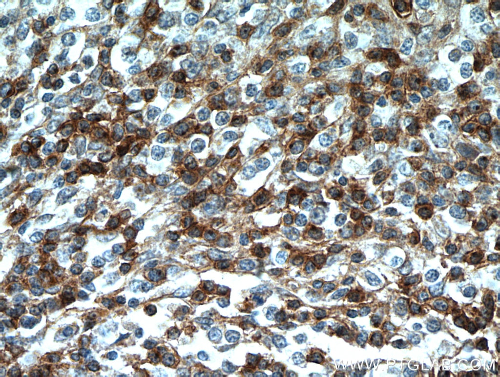 Immunohistochemistry (IHC) staining of human lymphoma tissue using CD7 Monoclonal antibody (60209-1-Ig)