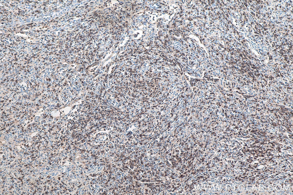 Immunohistochemistry (IHC) staining of human lymphoma tissue using CD7 Monoclonal antibody (60209-2-Ig)