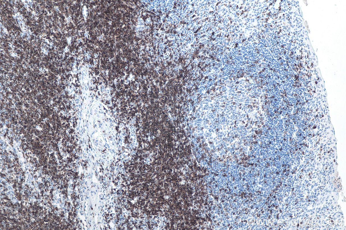 Immunohistochemistry (IHC) staining of human tonsillitis tissue using CD7 Monoclonal antibody (60209-2-Ig)