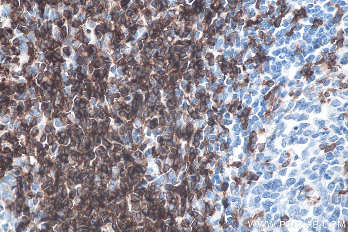 Immunohistochemistry (IHC) staining of human tonsillitis tissue using CD7 Monoclonal antibody (60209-2-Ig)