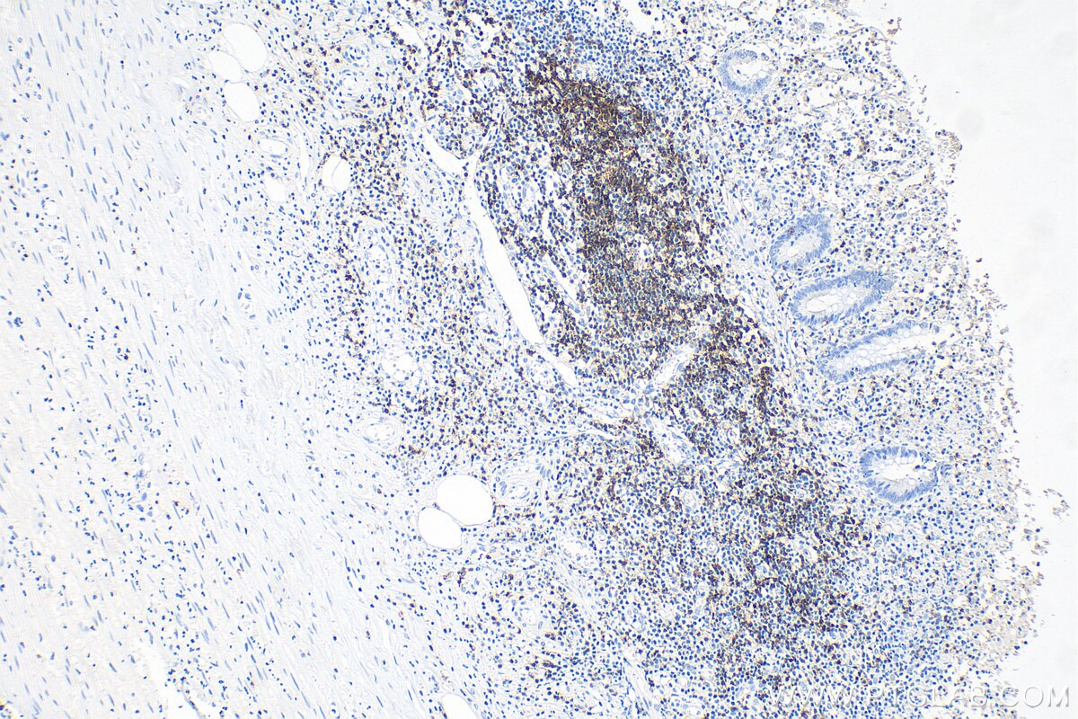 Immunohistochemistry (IHC) staining of human appendicitis tissue using CD7 Monoclonal antibody (60209-2-Ig)