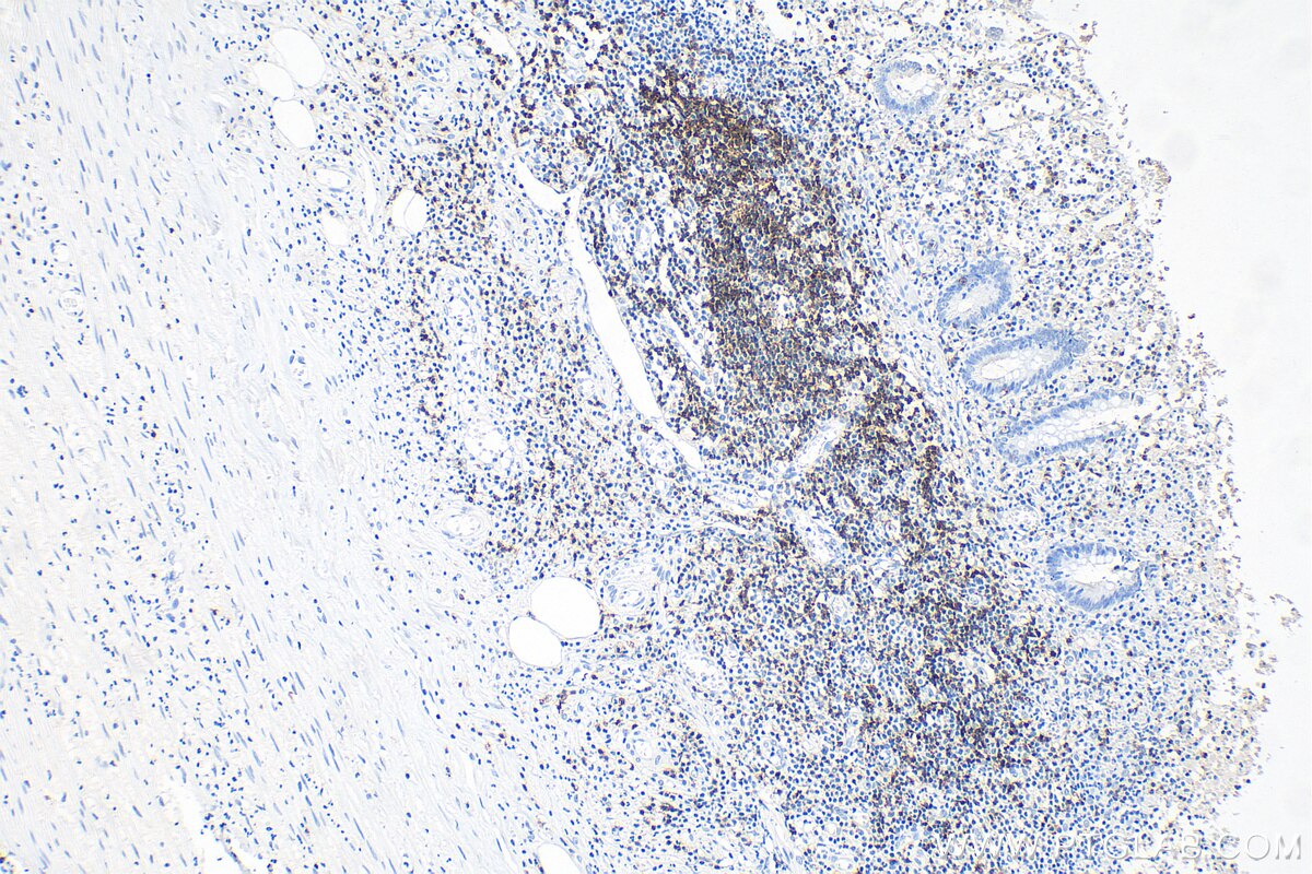 IHC staining of human appendicitis using 60209-2-Ig