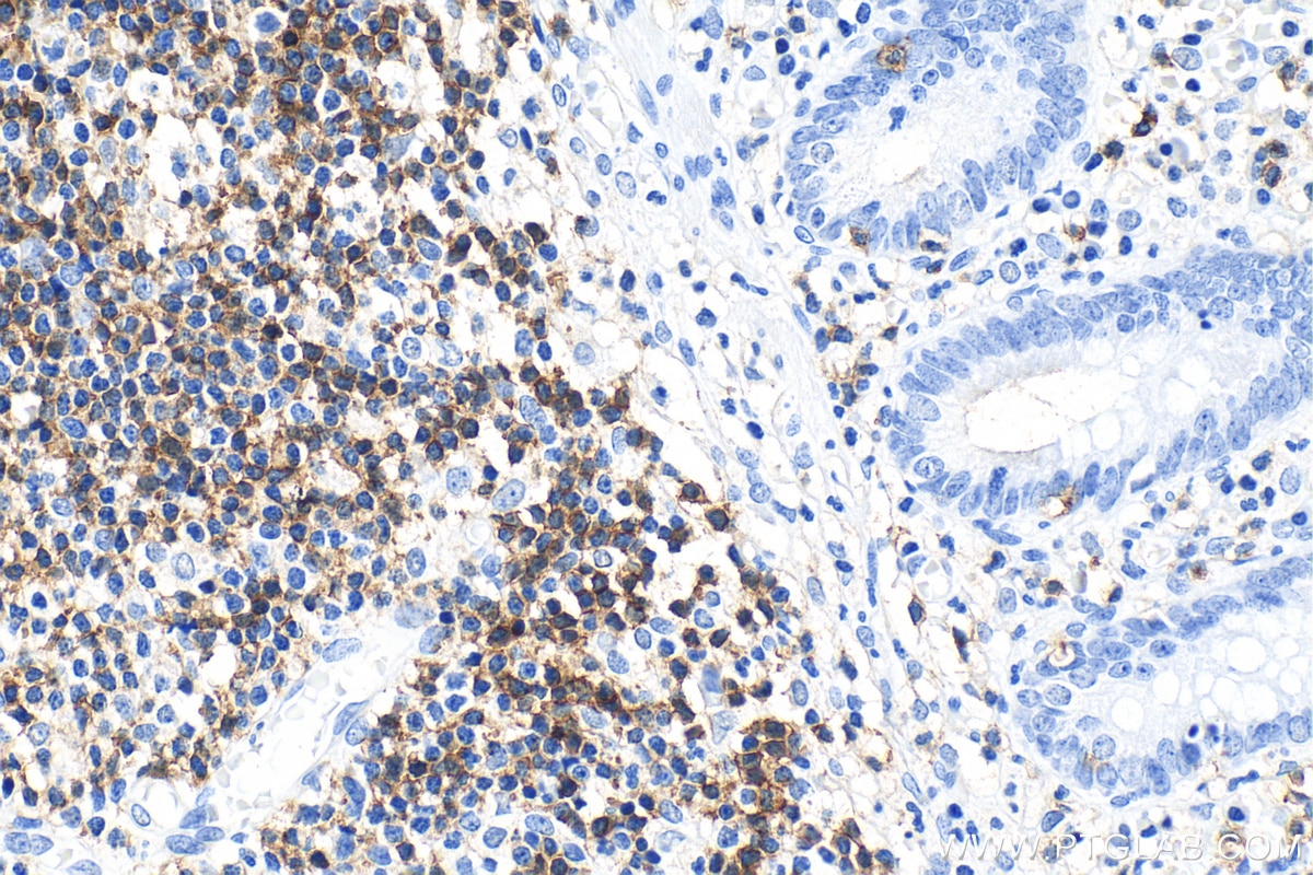 Immunohistochemistry (IHC) staining of human appendicitis tissue using CD7 Monoclonal antibody (60209-2-Ig)