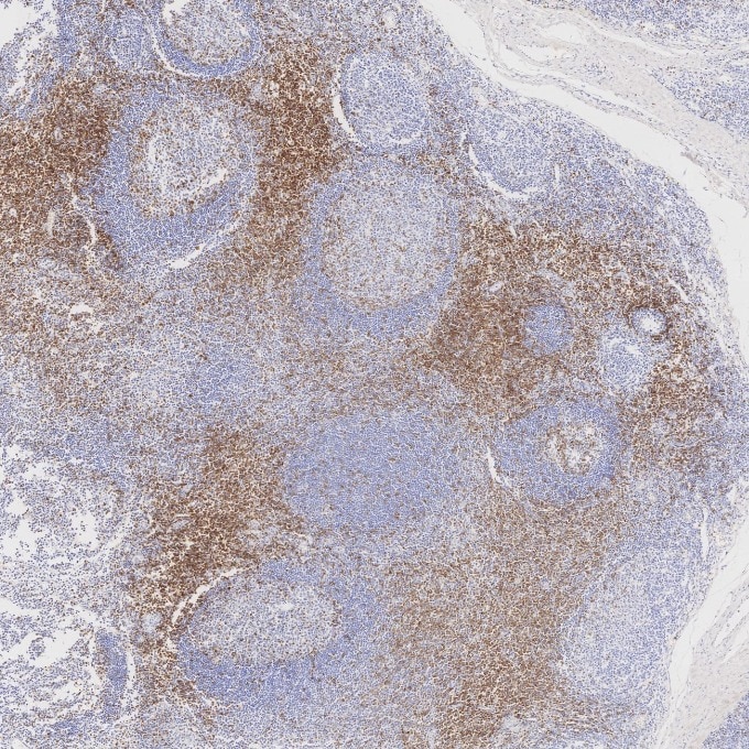 Immunohistochemistry (IHC) staining of human tonsillitis tissue using CD7 Monoclonal antibody (60209-2-Ig)