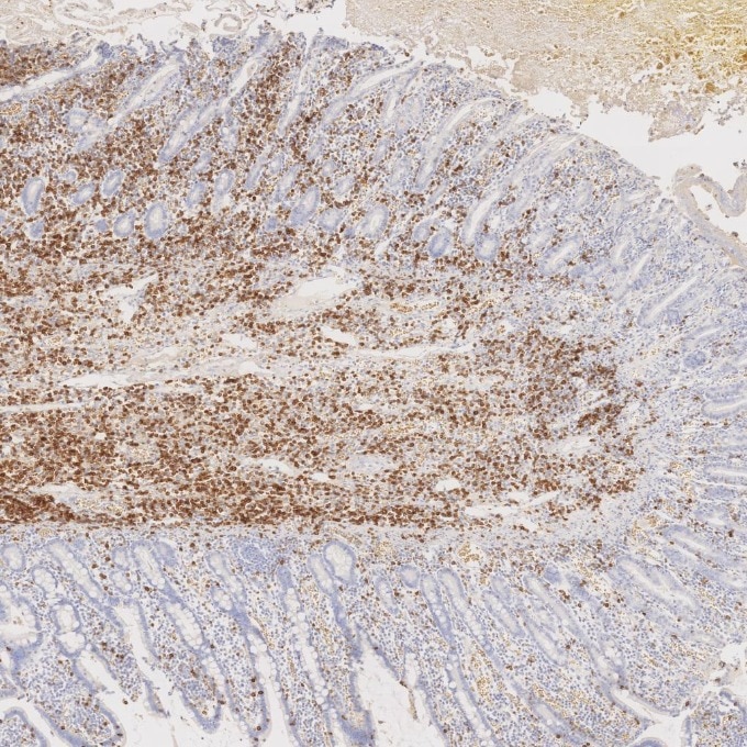 Immunohistochemistry (IHC) staining of human lymphoma tissue using CD7 Monoclonal antibody (60209-2-Ig)