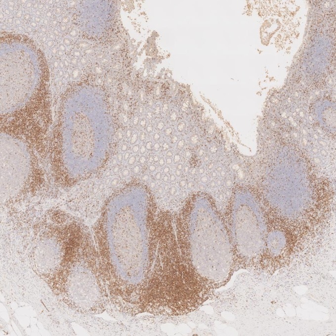 Immunohistochemistry (IHC) staining of human appendicitis tissue using CD7 Monoclonal antibody (60209-2-Ig)