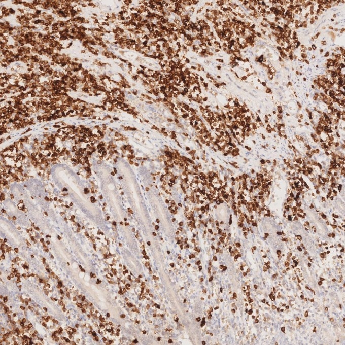 Immunohistochemistry (IHC) staining of human lymphoma tissue using CD7 Monoclonal antibody (60209-2-Ig)