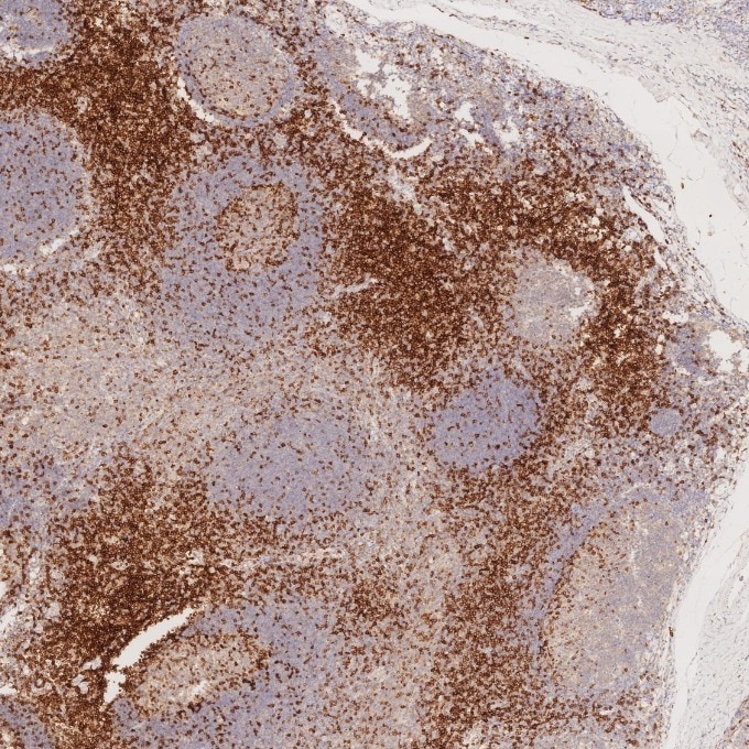 Immunohistochemistry (IHC) staining of human tonsillitis tissue using CD7 Monoclonal antibody (60209-2-Ig)