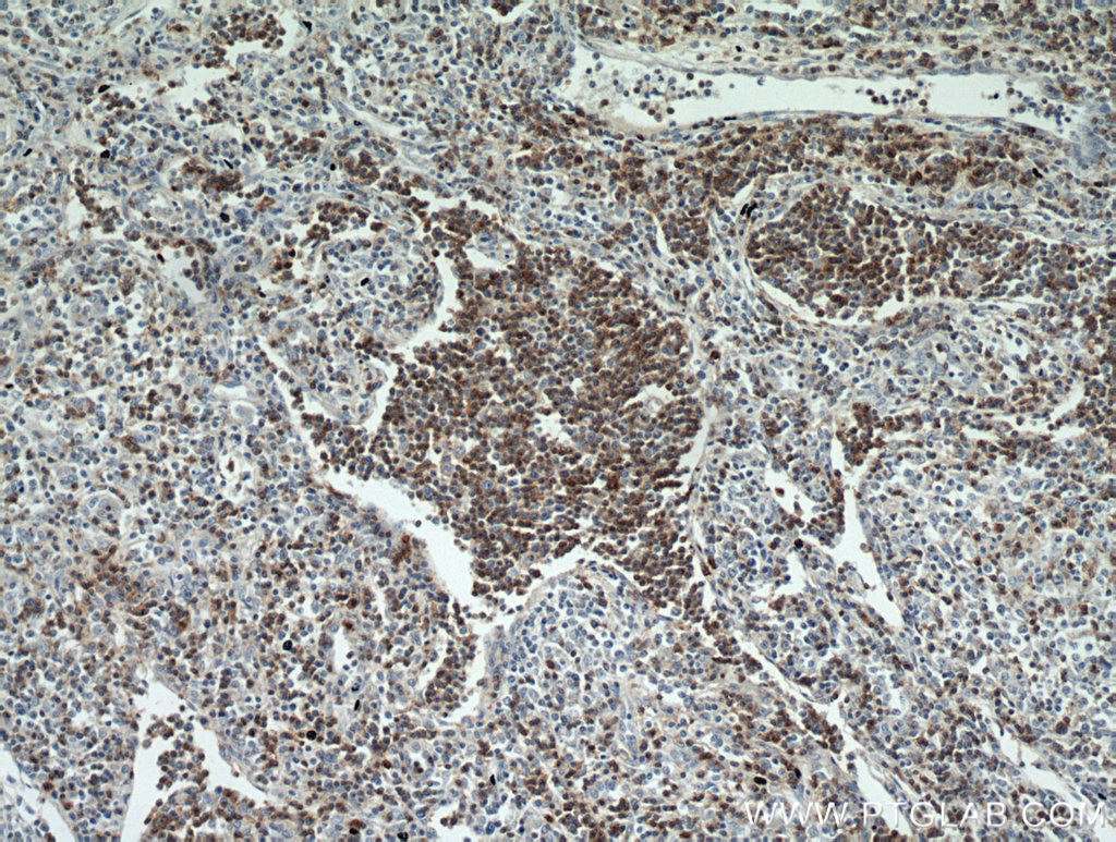 Immunohistochemistry (IHC) staining of human lymphoma tissue using CD7 Monoclonal antibody (60209-2-Ig)