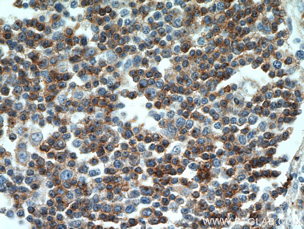Immunohistochemistry (IHC) staining of human lymphoma tissue using CD7 Monoclonal antibody (60209-2-Ig)