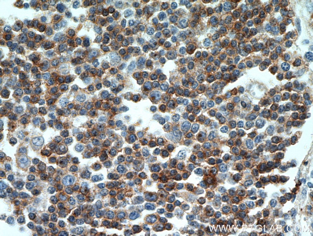 IHC staining of human lymphoma using 60209-2-Ig