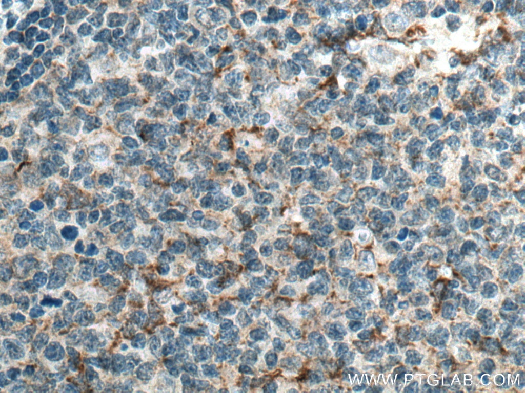 Immunohistochemistry (IHC) staining of human tonsillitis tissue using CD70 Monoclonal antibody (67749-1-Ig)