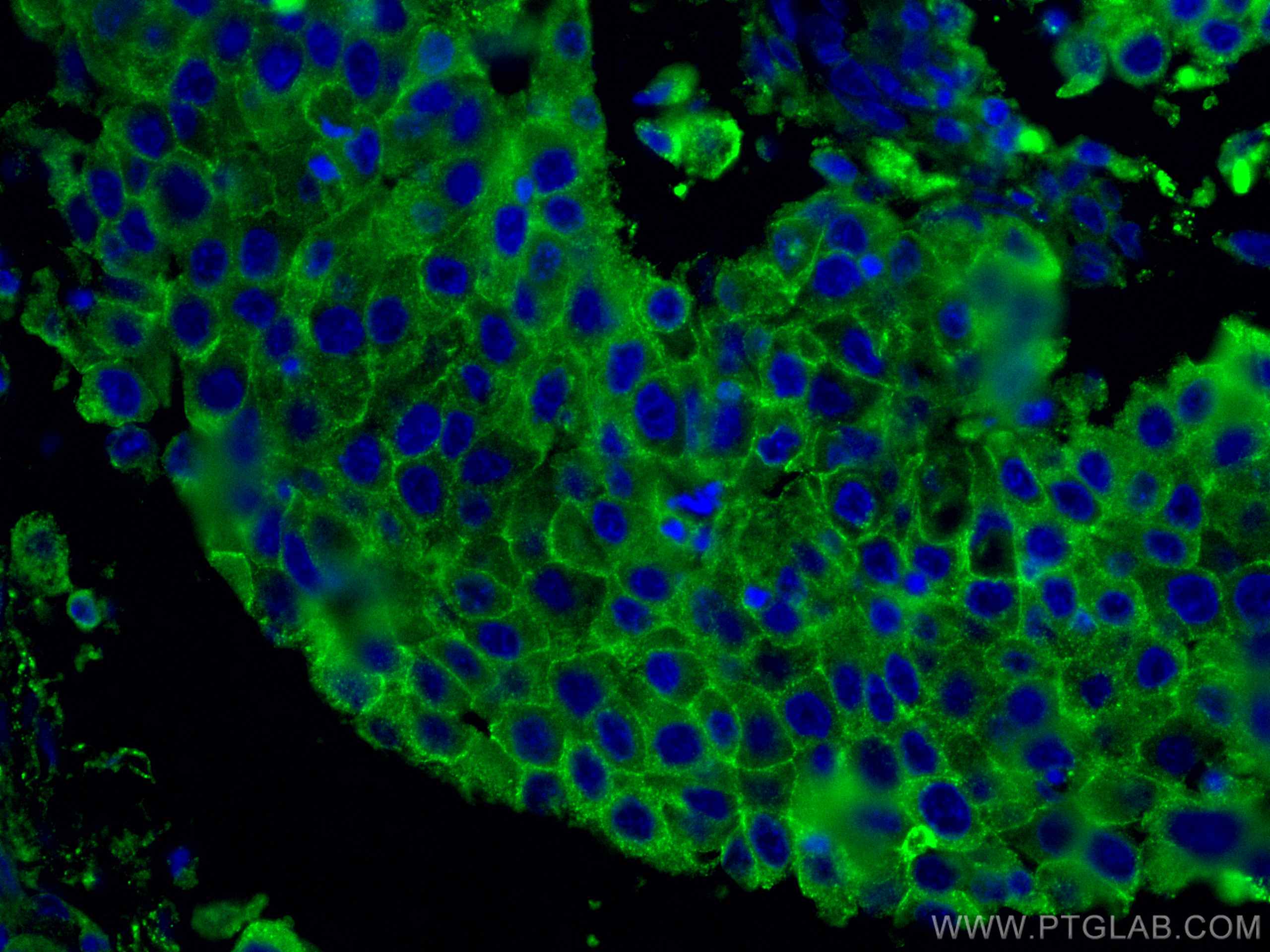 Immunofluorescence (IF) / fluorescent staining of human breast cancer tissue using CD71 Monoclonal antibody (66180-1-Ig)